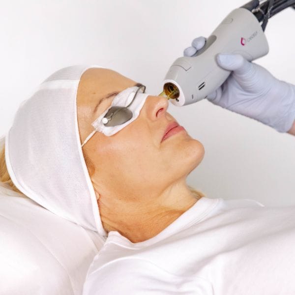Laser for Pigmentation - Nose
