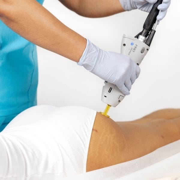Laser Hair Removal - Buttocks