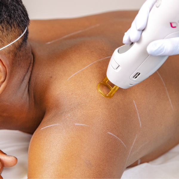 Laser Hair Removal - Shoulders