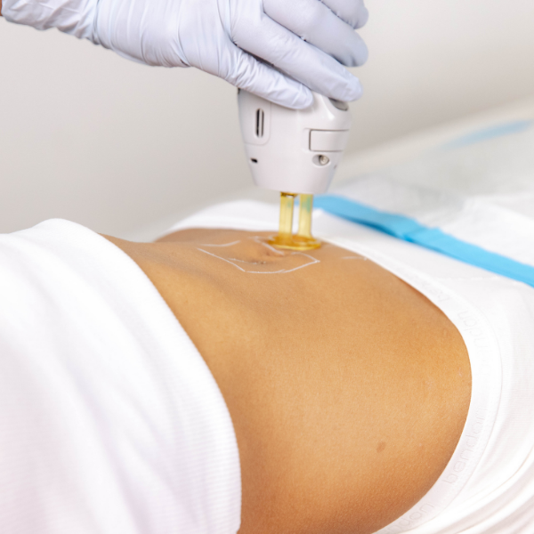 Laser Hair Removal - Snail Trail