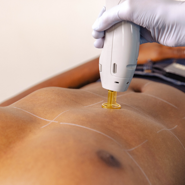 Laser Hair Removal - Stomach
