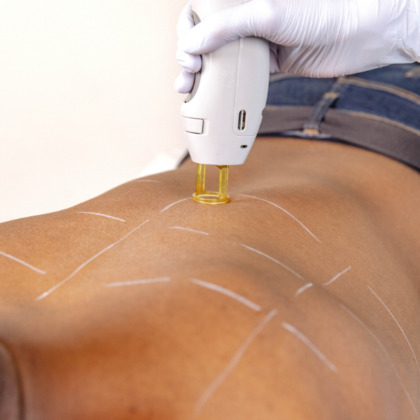 Laser Hair Removal - Back - Half