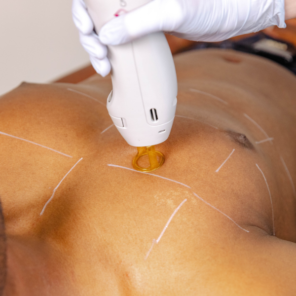 Laser Hair Removal - Chest