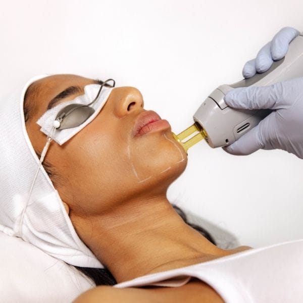 Laser Hair Removal - Chin