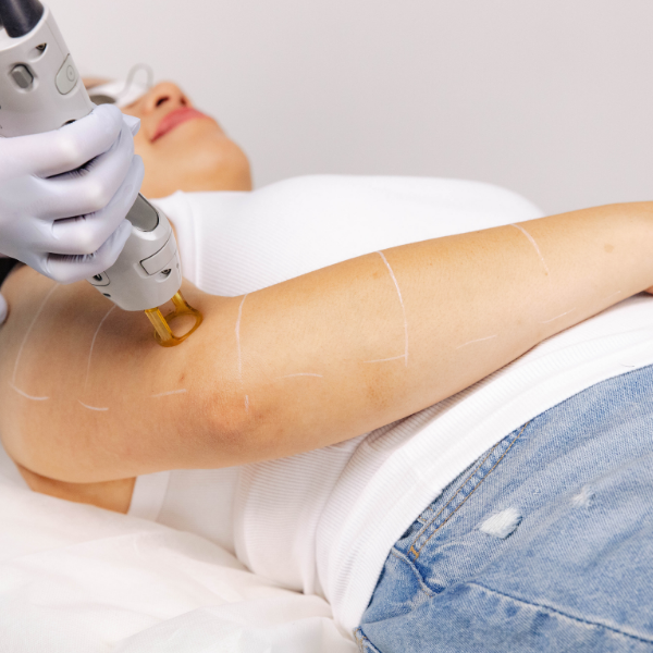 Laser Hair Removal - Arms - Full