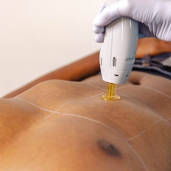 Laser Hair Removal - Chest+Stomach