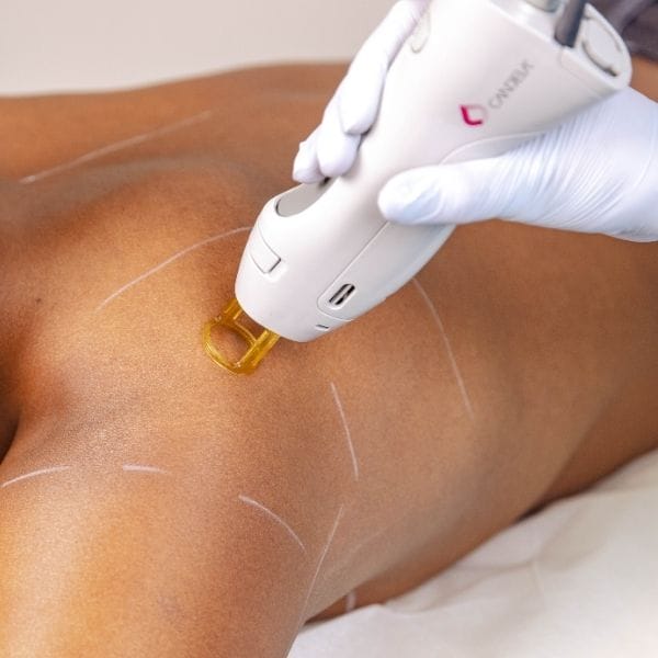 Laser Hair Removal - Back+Shoulders