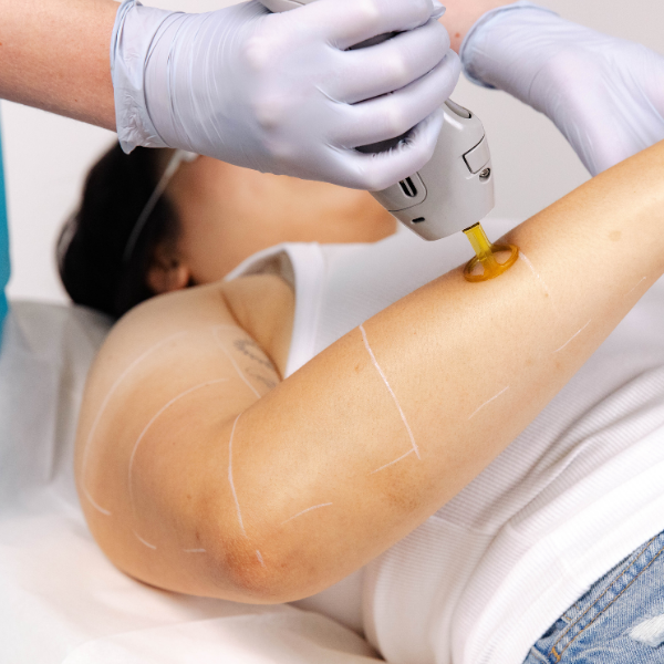 Laser for Pigmentation - Arms - Full