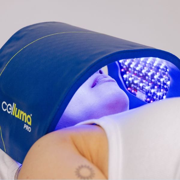 LED - Acne