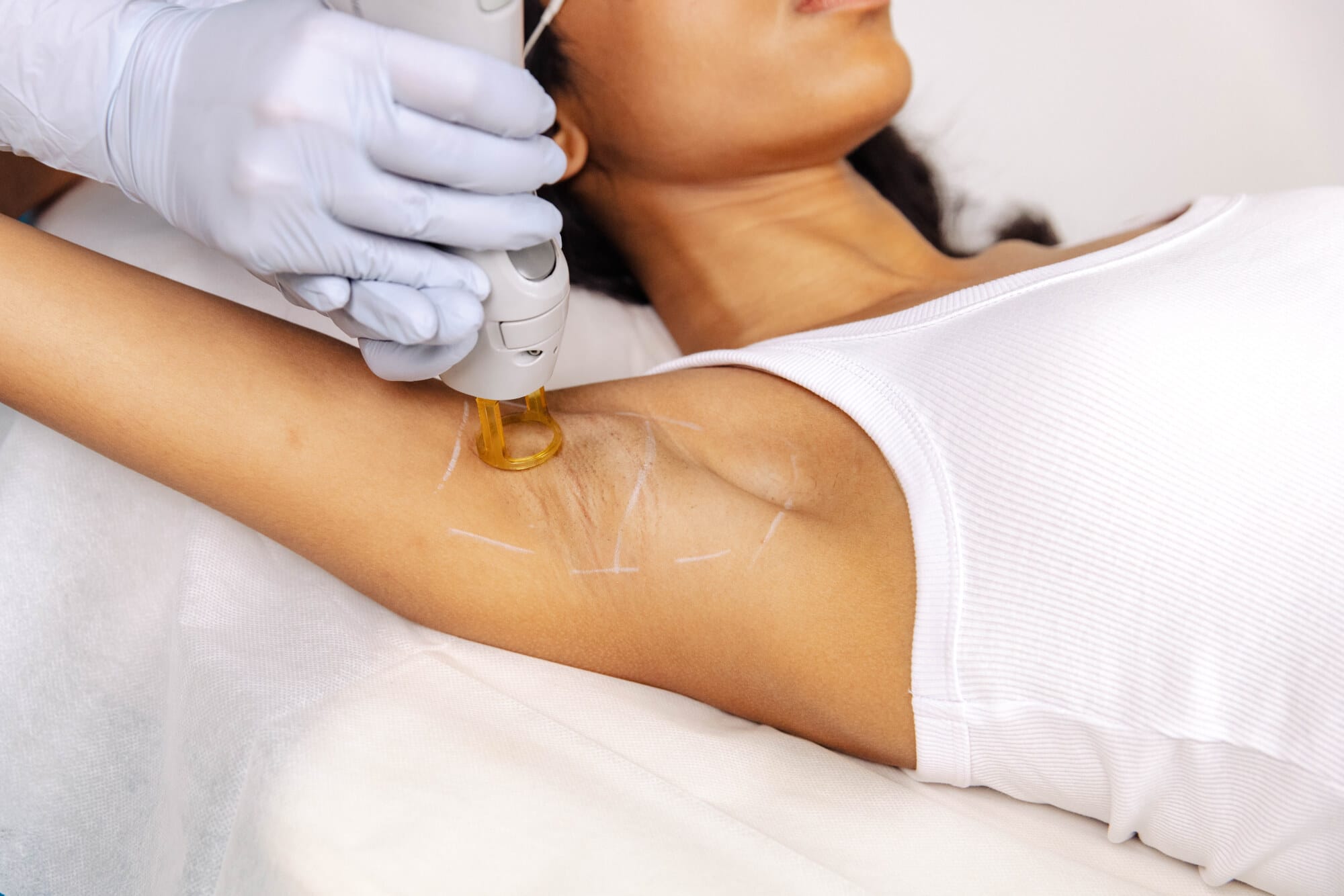 Laser Hair Removal - Underarms