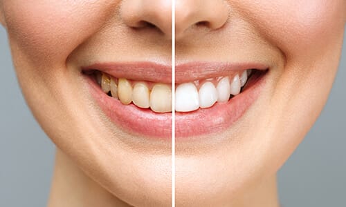 Smiling woman showing a contrast between yellow-stained teeth and whitened teeth.