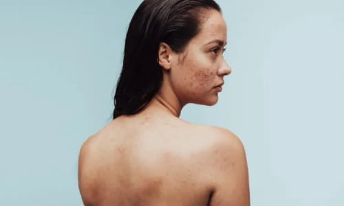 Girl with acne on her right cheek, turned slightly away from the camera.